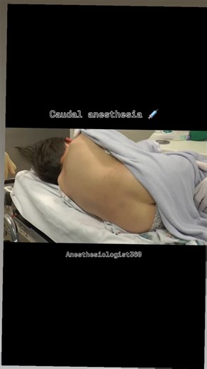Abdul Malik | The "Tailbone" Block 🦴 Caudal anesthesia is a regional anesthetic technique where local medication is injected into the epidural space... | Instagram
