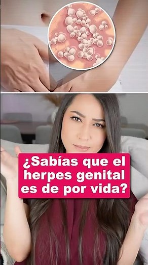 ¿Sabías que el herpes es una enfermedad de por vida? #herpes #salud #medicina #datos #información