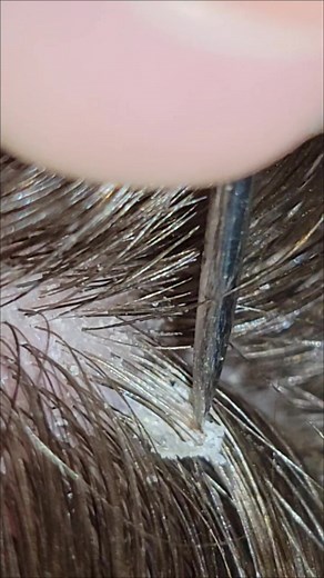 #lift #head #dandruff #picking #freshskin #scalp #dermatillomania #fypシ #skinpicking #scalppicker #scalpcare #scab #flake #scalppicking