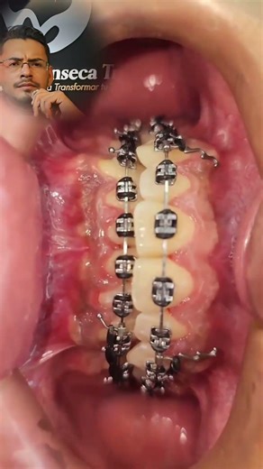 Black colored brackets #brackets #orthodontics #dentist
