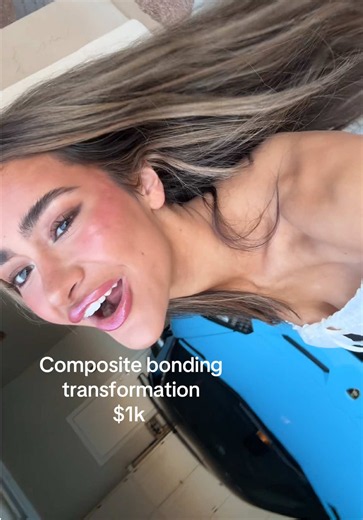 Composite bonding vs veneers: Scottsdale $1k transformation