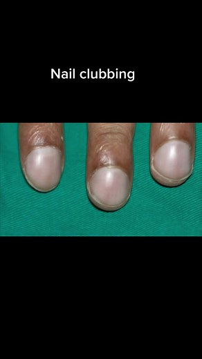 Nail Clubbing: Causes and Health Concerns Explained