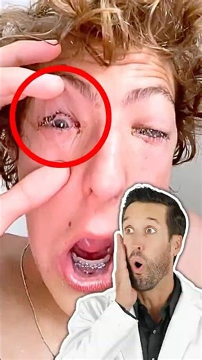 ER Doctor REACTS to Eye "Crust"