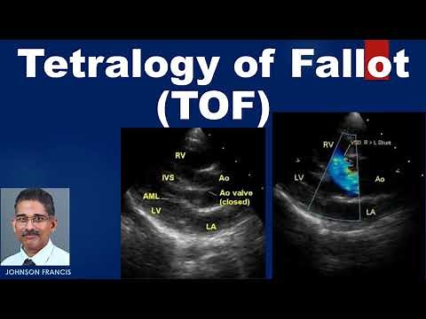 Tetralogy of Fallot TOF