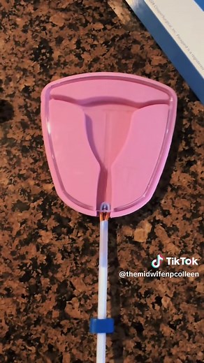 Paragard IUD Insertion Explained: Step-by-Step Guide