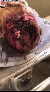 Dying While Eaten by Maggots