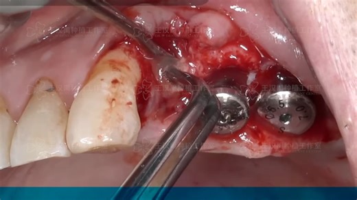 Kim Jaeyoon上颌后牙区早期种植+植骨病例手术视频