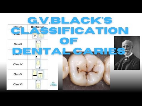 G.V.Black's Classification of Dental caries ..#dentist #dentistry #lecture #dentistrymadeeasy #bds