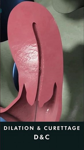 Dilation and Curettage D&C animation #uterinecancer #treatment