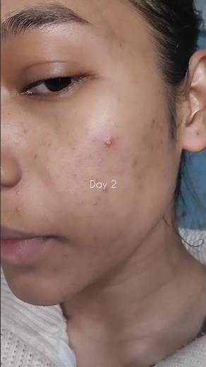 This is how I treat my pustule acne in 3 days 📅 #acnetreatment #acnejourney