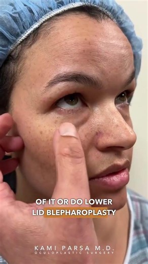 Dissolve Tear Trough Filler Before THIS Type of Surgery