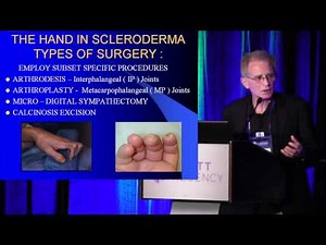 2013 Atlanta - The Hand In Scleroderma: Surgical Options - Dr. Charles Melone