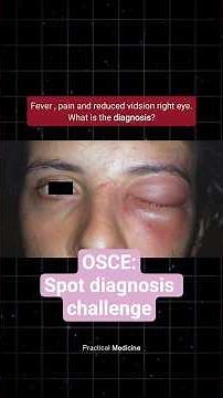 [OSCE: Picture test] Fever, pain eye and reduced vision. What is the diagnosis?