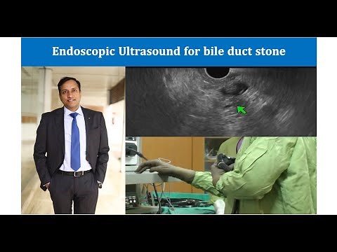 Endoscopic Ultrasonography for CBD stone evaluation : Dr Vikas Singla