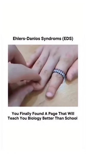DNA_Decoded on Instagram: "Ehlers-Danlos syndrome (EDS) is a group of genetic connective tissue disorders that cause hypermobile joints, soft and stretchy skin, and fragile skin that bruises easily. The main cause 59 is a genetic mutation leading to weak collagen, which can result in complications like chronic joint pain, dislocations, early-onset arthritis, and, in some cases, life-threatening organ and blood vessel rupture. The most common type is hypermobile EDS, though other types like class