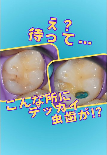 神戸三宮での虫歯治療の裏側