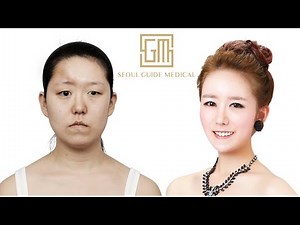 Korean Reconstructive Plastic Surgery Transformation | Seoul Guide Medical