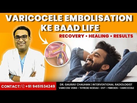 Varicocele Embolisation के बाद ज़िंदगी कैसी होती है? | Full Recovery Guide | Dr. Gaurav Chauhan