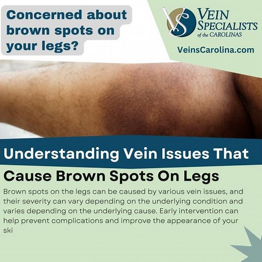 5 Vein Conditions That Cause Brown Spots On Legs