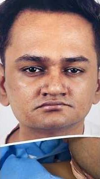 Maxillary Advancement and Clock Wise Rotation with Deep Bite Occlusal correction and Chin Contouring