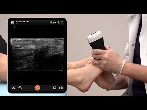 How to Assess for Morton's Neuroma