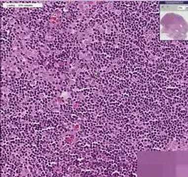 Histopathology Lymph node-- Metastatic breast carcinoma