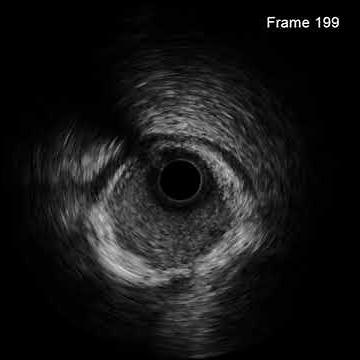 intramural hematoma.
