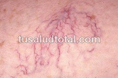 Cómo Quitar las Arañitas de las Piernas: 2 Recetas Efectivas