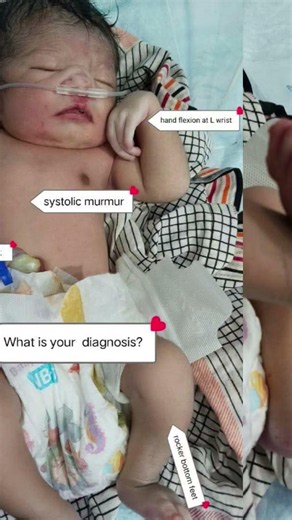 Edwards Syndrome (Trisomy 18) #fcps #doctor #medicaleducation #md