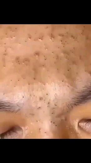 Pimple Popping 2021 | Like this video for Part 2....#fyp #pimplepoppingvideos | Instagram