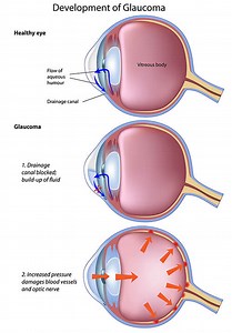Glaucoma Minneapolis | Glaucoma Treatment Minnesota | MN Eye