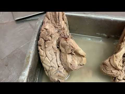 Inferior surface of the brain -sulci and gyri.