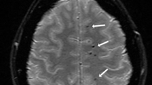 URMC research opens door for a blood test to diagnose concussion injury and recovery