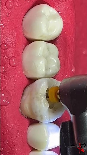 Small Cavity Big DAMAGE! #rootcanaltreatment