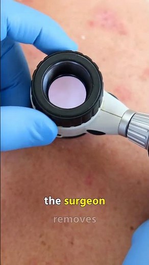 MOHS Surgery explained |by DrLi