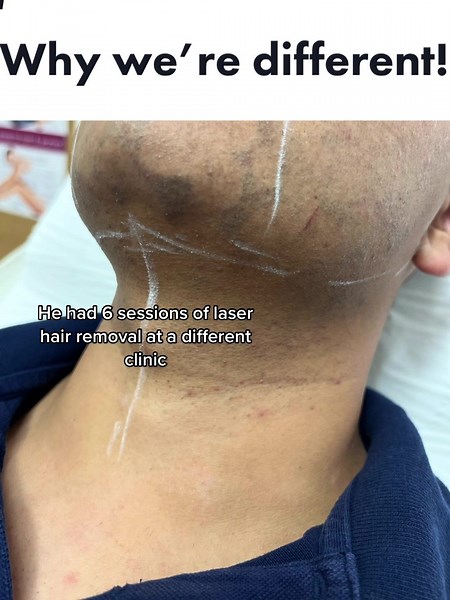 Effective Laser Hair Removal Process Explained