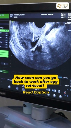 When Can You Go Back to Work After Egg Retrieval? IVF Recovery Explained - Dr Rhythm Gupta