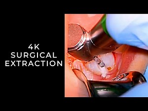 Surgical Tooth Extraction • Video • MEDtube.net