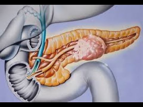 Non-functioning Pancreatic neuroendocrine tumors (PNET)