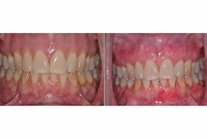 Pinhole Surgical Technique Miami | Dr. John Gallardo, DDS