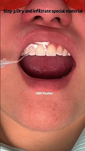 White spots on teeth procedure | icon dental treatment | Dr. Yazdan | remove white spots on teeth