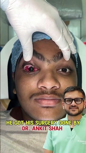 Squint Strabismus Surgery Explained Causes, Treatment & Recovery