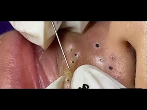 Huge Blackhead Popping on Nose – Deep Pore Cleanse
