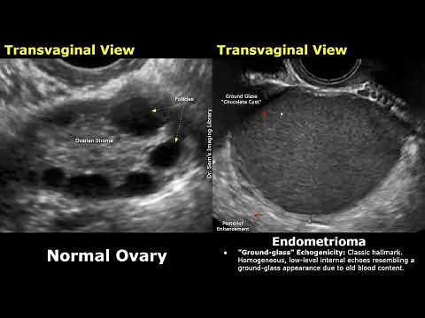 Ovary Ultrasound Normal Vs Endometrioma Imaging Findings | Chocolate Cyst. Ground Glass Appearance