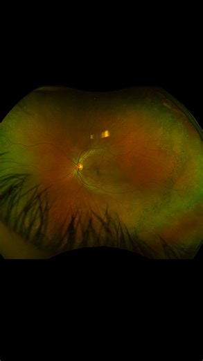 See why Optomap is so important😱😱 Visit our clinic 📍31 Rexdale blvd, next to BMO Book an appointment ⬇️⬇️ ☎️416-249-2020 📧info@drpink.ca #optometrist #toronto #eyeexam #dryeyeclinic #etobicoke #eyedoctor #medicalaesthetician #dryeyedisease #rfforma #ipllumecca #eyeclinic #glasses#eyewear #dryeyes #mgd#DrPinkEye #AestheticMedicine #NorthYorkBeauty #BotoxToronto #LipFillerExpert #SkinGoals #YouthfulSkin #GlowWithPink | drpink.ca