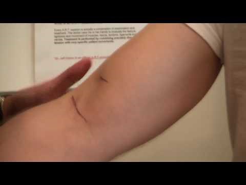 Biceps Crease Interval Test