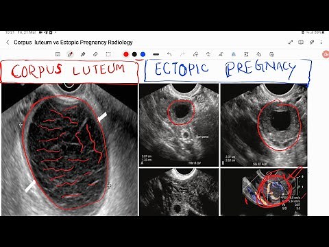 Tubal ectopic pregnancy vs corpus luteal cyst how to Differentiate in Ultrasound feature (made easy)