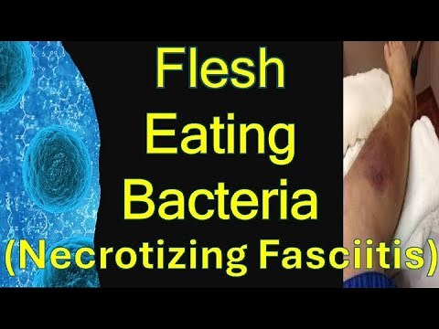 Flesh Eating Bacteria / Necrotizing Fasciitis Disease