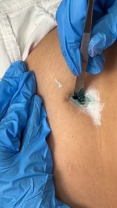 2.9M views · 6.4K reactions | Strange insect removed from belly This original video was produced by Rick Lax and Alex Z. | Possibly Genius | Facebook