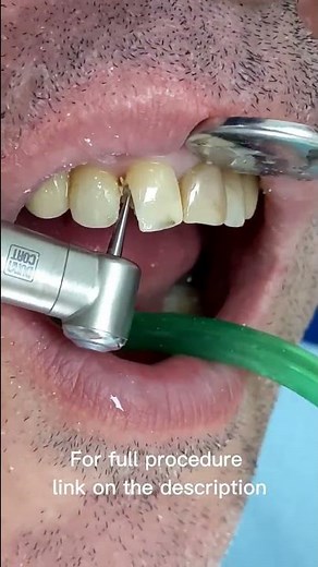 Tooth Decay Treatment